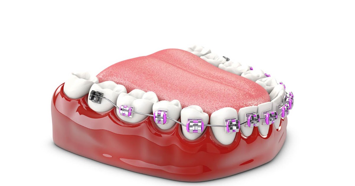 SureSmile vs. Invisalign: Key Differences Explained