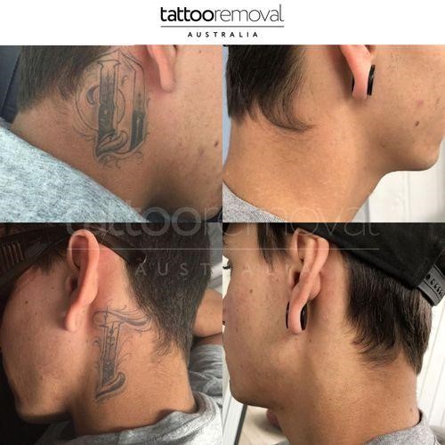 Why Aftercare for Tattoo Removal Matters More Than You Think